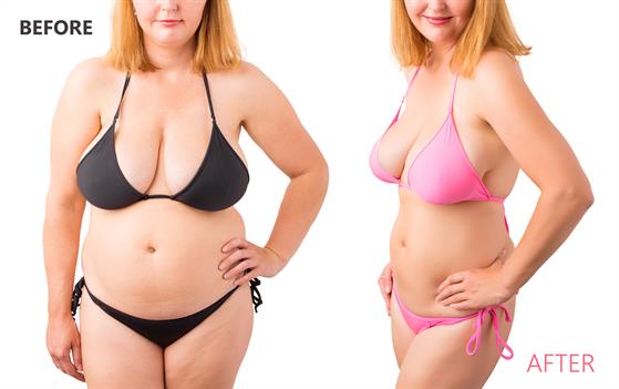 Tummy Tuck Before and After Milwaukee